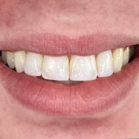 Composite Bonding - Smile 5 before